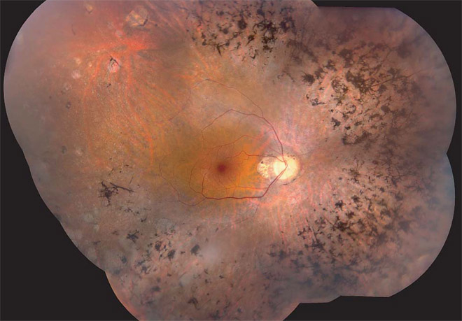 Figure 1: Ophthalmoscopic abnormalities in a patient with MAK mutations...